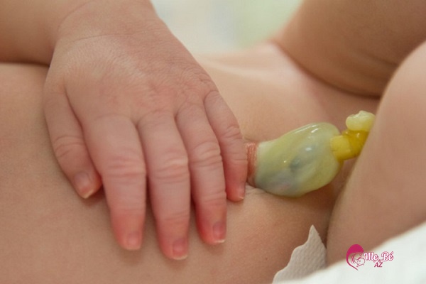 Màu sắc rốn trẻ sơ sinh