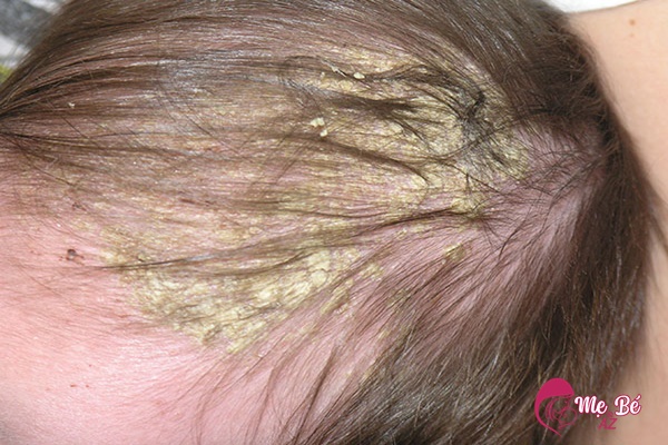 Cứt trâu ở đầu khiến bé ngứa ngáy, khó chịu