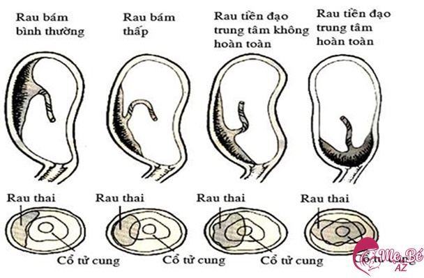 Các dạng bám của nhau tiền đạo