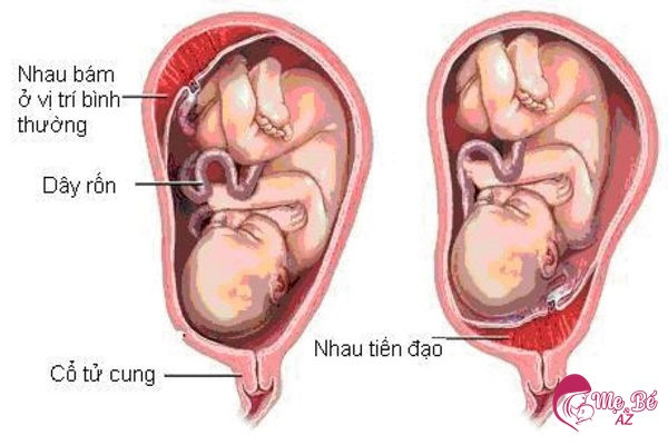 Vị trí bám nhau thai bình thường và nhau tiền đạo