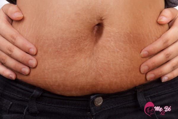 Nội tiết tố thay đổi làm bụng trở nên thâm rạn sau khi sinh