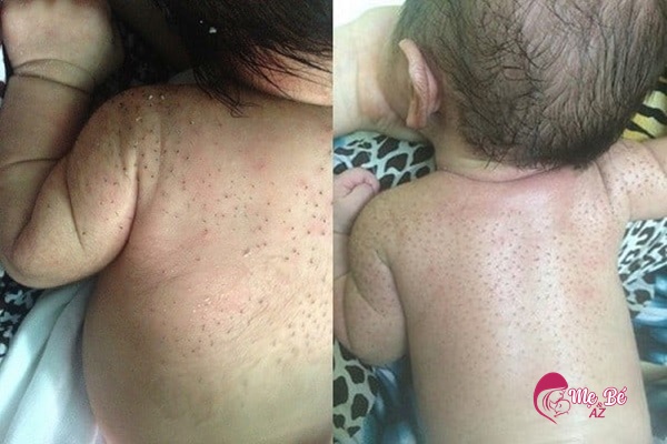 Trẻ sơ sinh với lớp lông măng