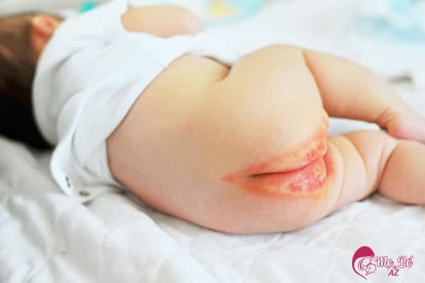 Hình ảnh bé bị hăm tã