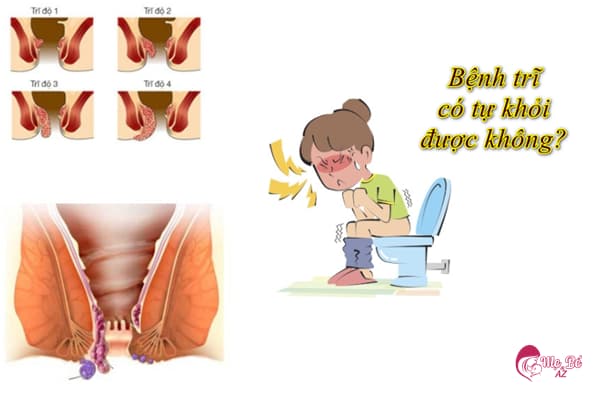 Bệnh trĩ sau sinh