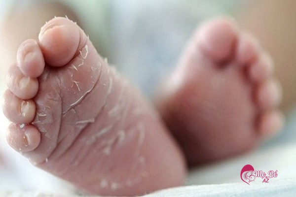 Bong tróc da ở trẻ sơ sinh