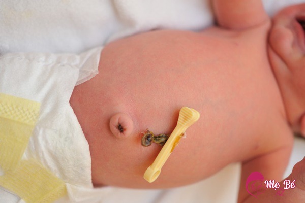 Rốn trẻ sau khi rụng cần được chăm sóc kỹ lưỡng