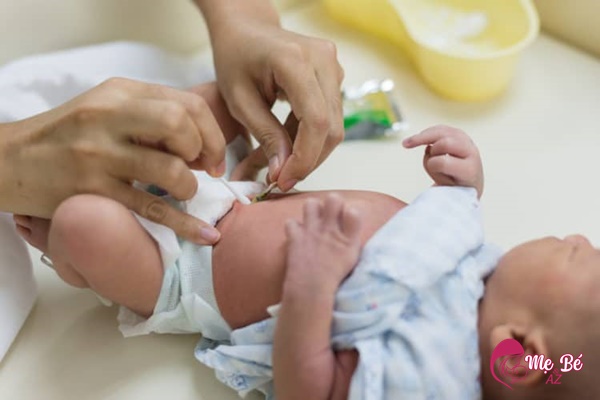 Tránh những sai lầm khi chăm sóc rốn cho trẻ sơ sinh