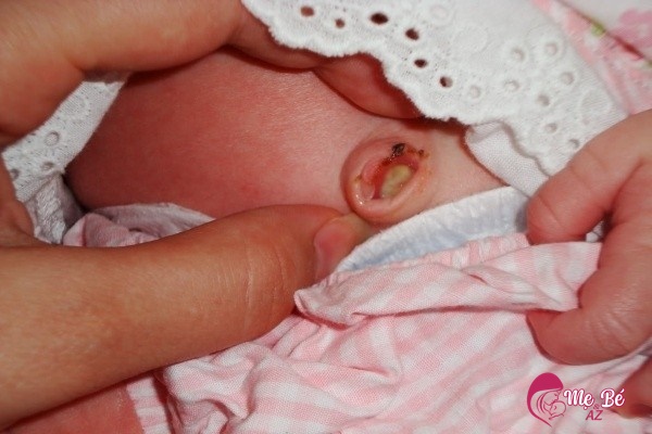 Cách xử lý khi bé bị viêm rốn nhẹ