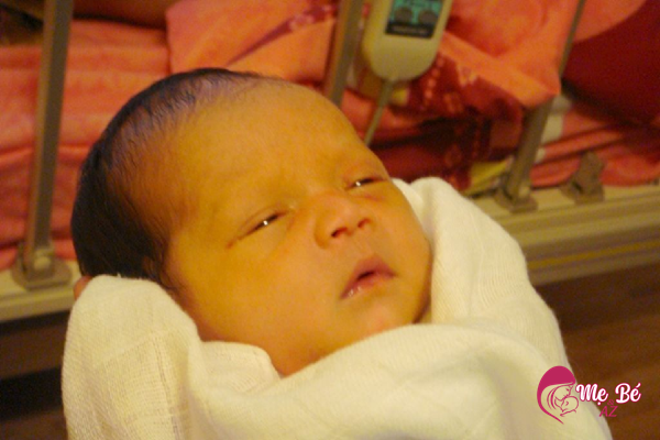 Vàng da ở trẻ sơ sinh rất phổ biến