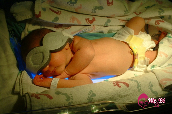 Mẹ nên phơi nắng đúng cách cho trẻ sơ sinh bị vàng da