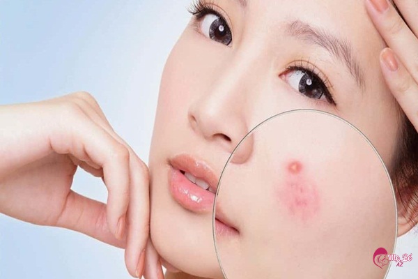 Phụ nữ có thai bị nổi mụn do thay đổi nội tiết tố trong thai kỳ