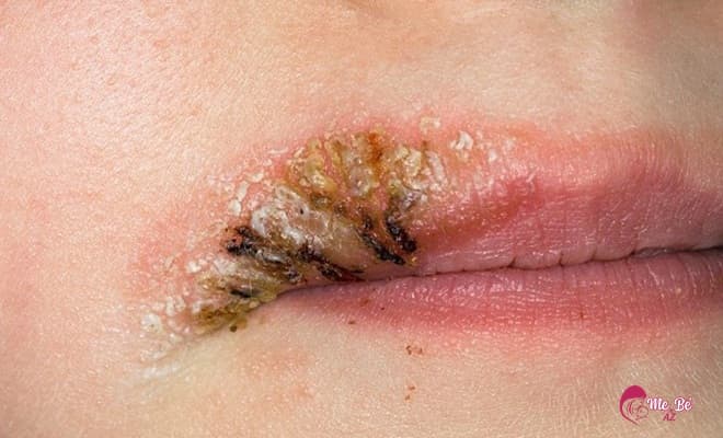 Có thai thì không nên xăm, phun môi