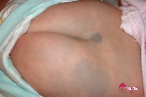 Bớt xanh ở lưng trẻ sơ sinh