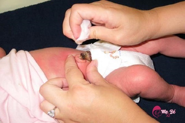 Nhiễm trùng rốn trẻ sơ sinh: Nguyên nhân, dấu hiệu và cách phòng tránh Nguyên nhân gây nhiễm trùng rốn trẻ sơ sinh