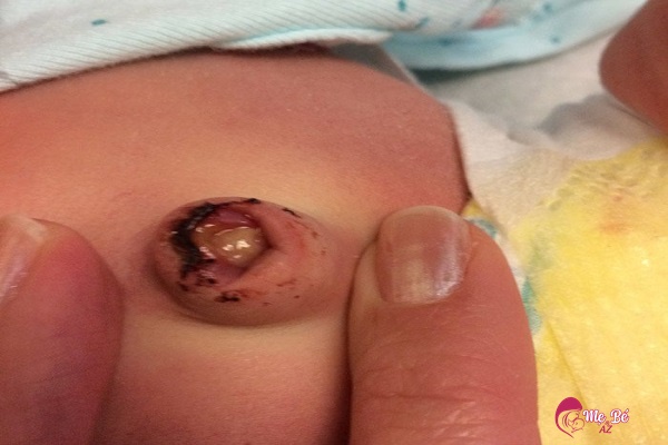 Nhiễm trùng rốn trẻ sơ sinh: Nguyên nhân, dấu hiệu và cách phòng tránh Rốn trẻ sơ sinh bị viêm có mủ