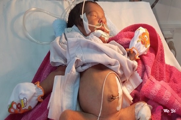 Nhiễm trùng rốn trẻ sơ sinh: Nguyên nhân, dấu hiệu và cách phòng tránh Trẻ bị nhiễm trùng rốn phải nhập viện