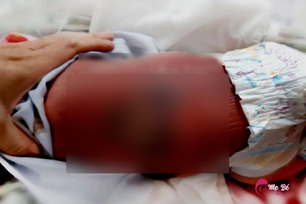 Nhiễm trùng rốn trẻ sơ sinh: Nguyên nhân, dấu hiệu và cách phòng tránh Rốn trẻ sơ sinh bị hoại tử