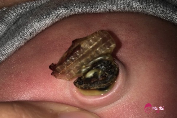 Nhiễm trùng rốn trẻ sơ sinh: Nguyên nhân, dấu hiệu và cách phòng tránh Rốn trẻ sơ sinh bị nhiễm trùng thay đổi màu sắc