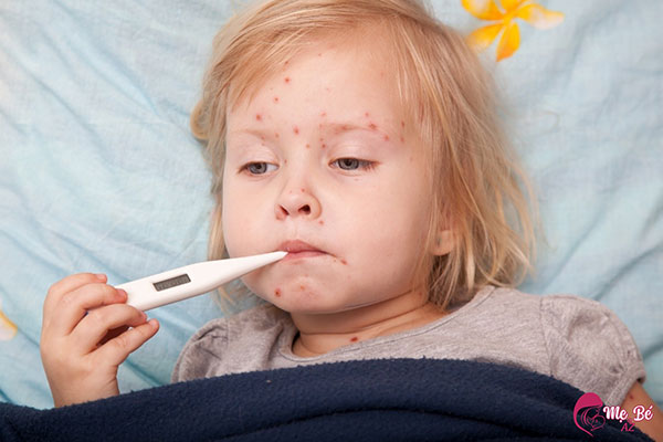 Hình ảnh trẻ bị thủy đậu