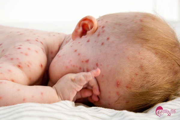 Trẻ gãi vết ngứa