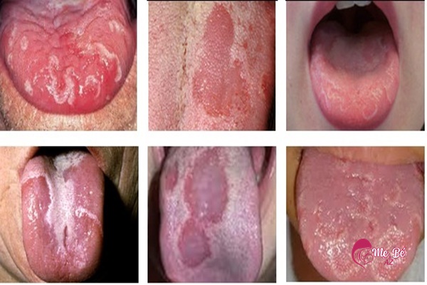 Nấm chính là thủ phạm khiến lưỡi bé có màu trắng