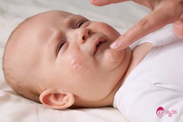 Mụn kê ở trẻ sơ sinh: Nguyên nhân, cách xử lý và những điều cần lưu ý Chăm sóc da cho trẻ bị mụn kê