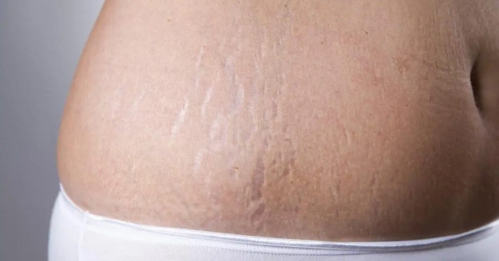 Trị Rạn Da Sau Sinh: Phương Pháp Nào Hiệu Quả?