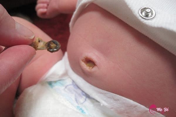 Rốn trẻ sơ sinh bị nhiễm trùng