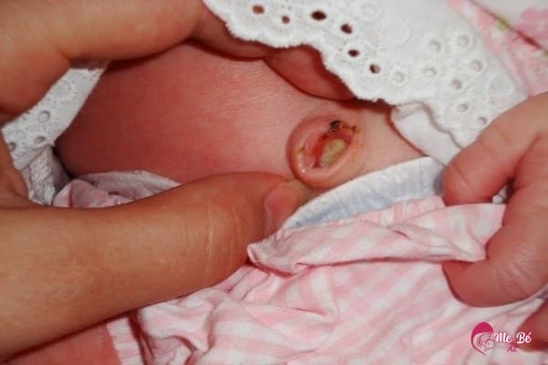 Rốn trẻ sơ sinh đã rụng nhưng có mủ màu vàng