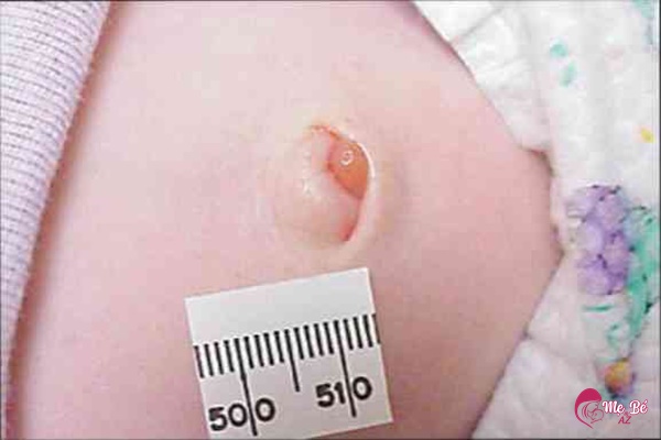 Tình trạng viêm nhiễm rốn ở trẻ sơ sinh