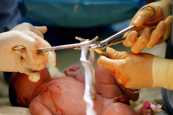 Cắt rốn trẻ sơ sinh
