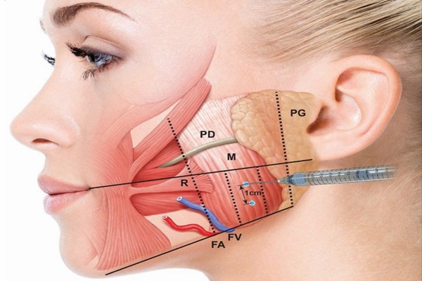 Thon gọn hàm V-line bằng Botox: Giải pháp cho khuôn mặt thon gọn