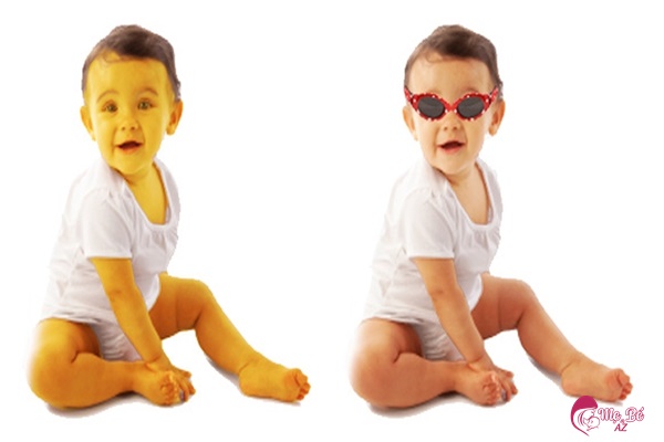 Trẻ bị vàng da bệnh lý toàn thân