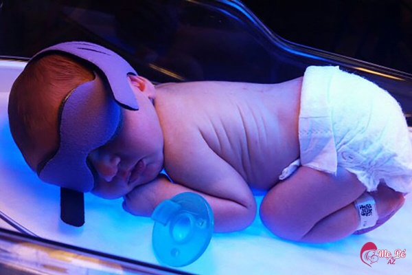 Trẻ được chiếu đèn điều trị vàng da
