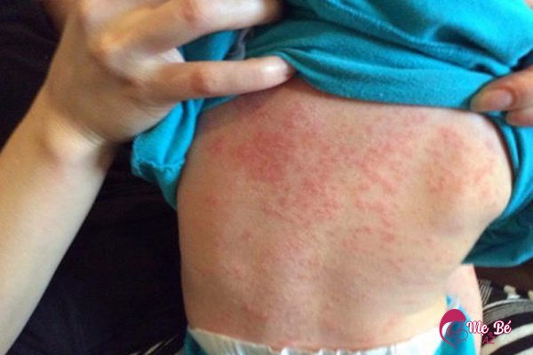 Lây lan bệnh sởi