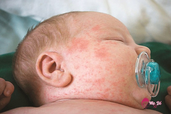 Không tự ý dùng kháng sinh khi trẻ bị sởi