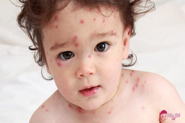 Bé bị thủy đậu nhưng không sốt
