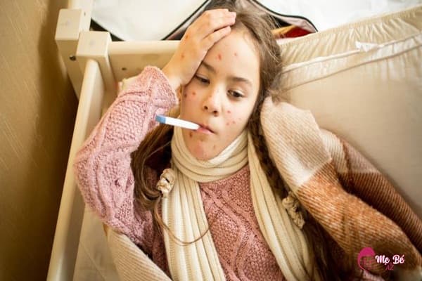 Trẻ em bị thủy đậu có sốt không