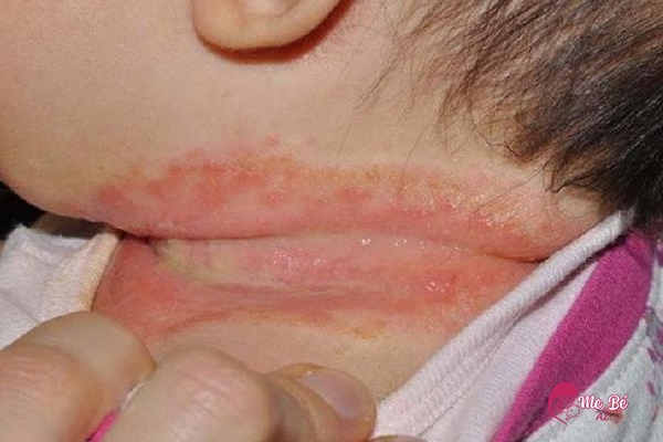 Sữa chảy xuống cổ gây hăm