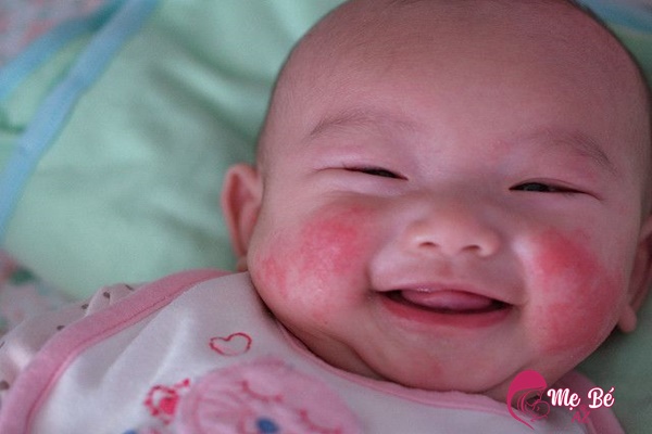 Mụn sữa đa phần tự hết sau 1 - 2 tuần