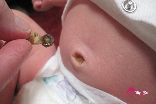 Cẩn trọng khi thấy rốn trẻ rỉ dịch