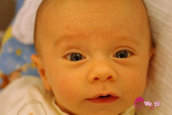 Trẻ sơ sinh bị vàng da hơn 1 tháng vãn chưa hết cần nghĩ tới vàng da bệnh lý