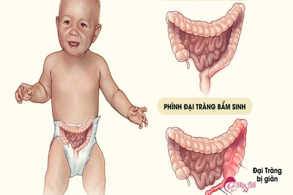 Hình ảnh minh họa trẻ bị phình đại tràng