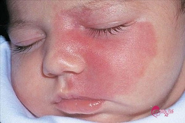 U máu ở trẻ sơ sinh là lành tính