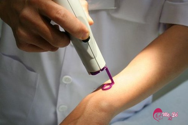 Điều trị u máu cho bé cũng không quá phức tạp