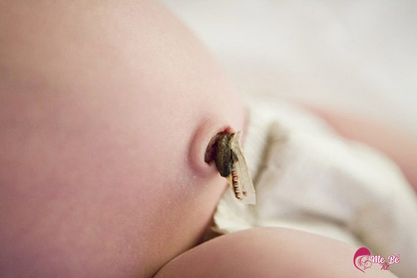 Mô tả chồi rốn ở trẻ sơ sinh